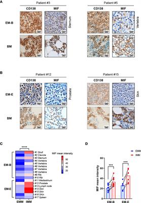 Intratumor Heterogeneity of MIF Expression Correlates With Extramedullary Involvement of Multiple Myeloma
